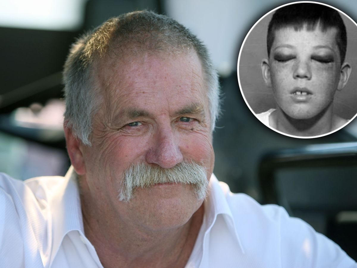 Cień szpikulca do lodu: Czym była lobotomia i jak zniszczyła dzieciństwo Howarda Dully’ego?